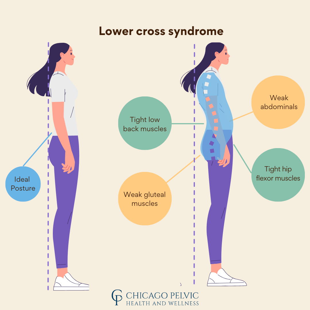 Lower Crossed Syndrome Muscle Imbalances and Pelvic Floor Dysfunction